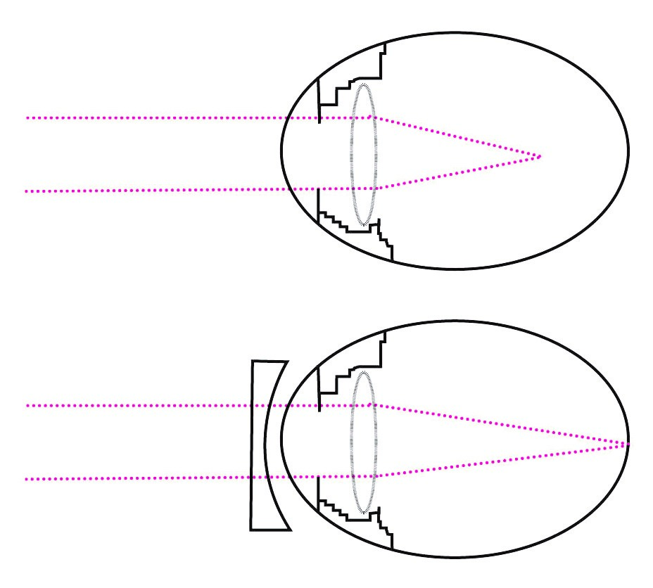 Een oog met myopie, zonder correctie (boven) en met correctie (onder).